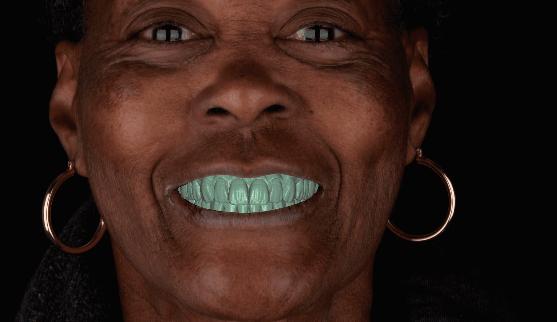 Full Denture