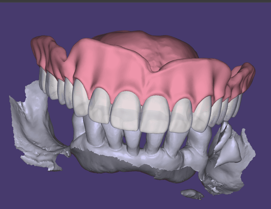 Full Denture