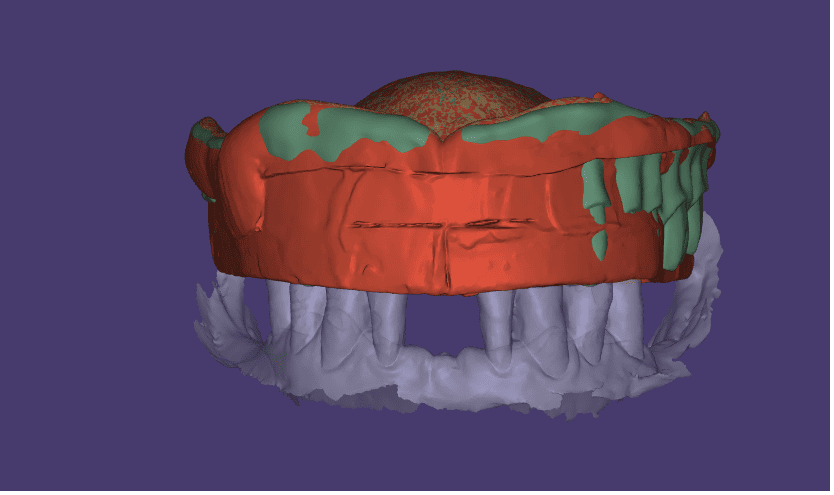 Full Denture