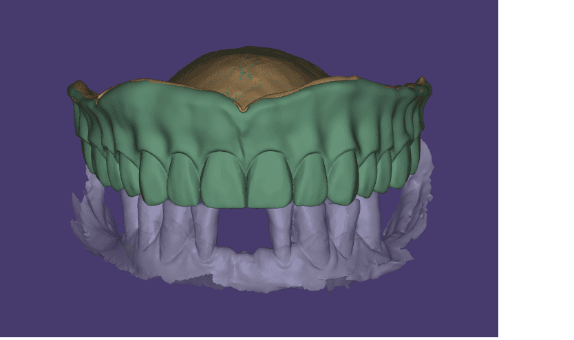 Full Denture