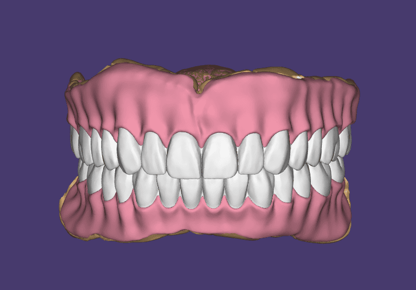Full Denture