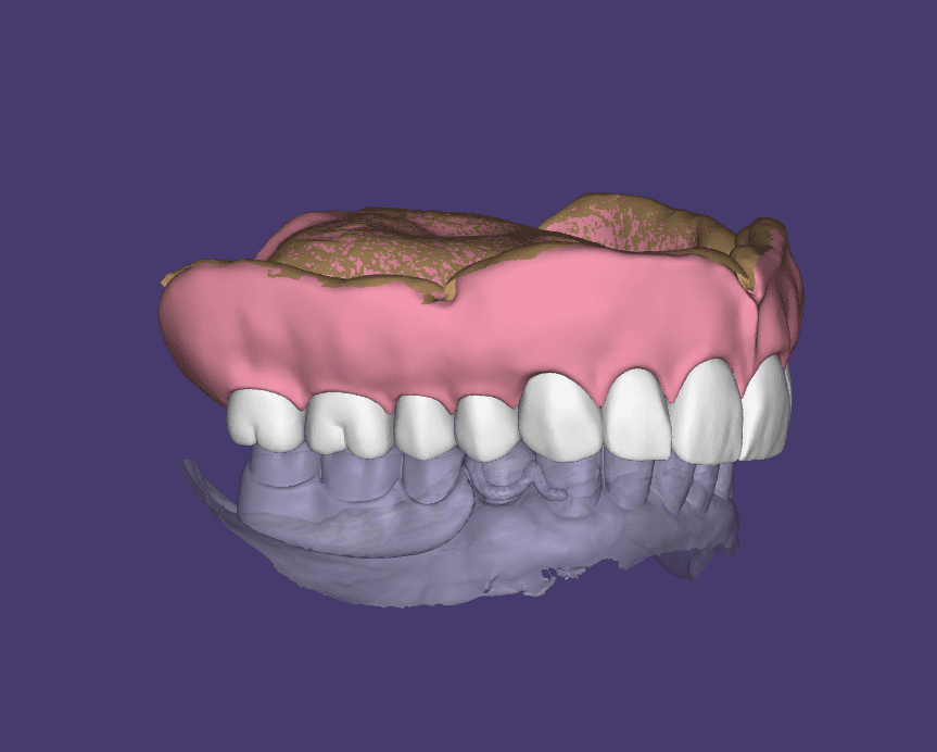 Full Denture