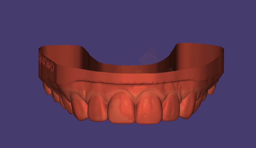 Gum Reduction Guide