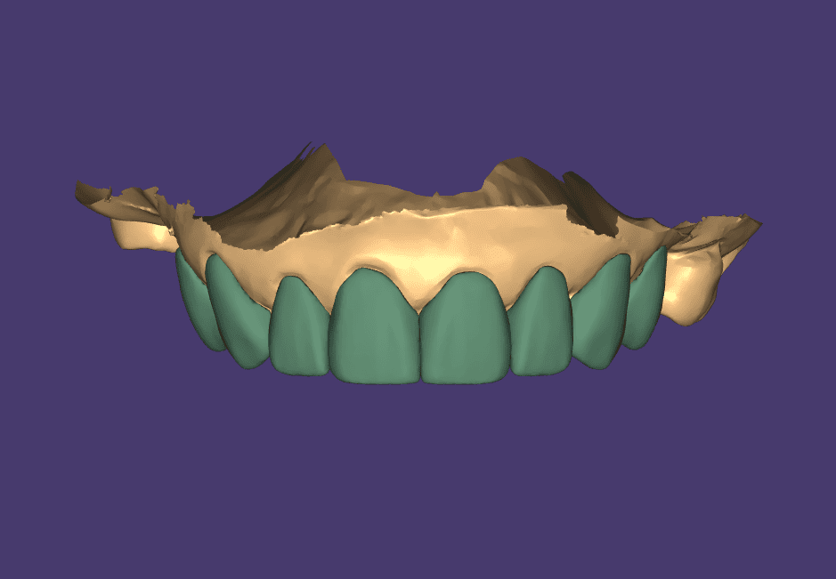 Veneer Inlay Onlay