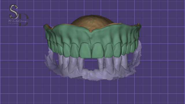 Full Denture