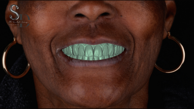 Full Denture