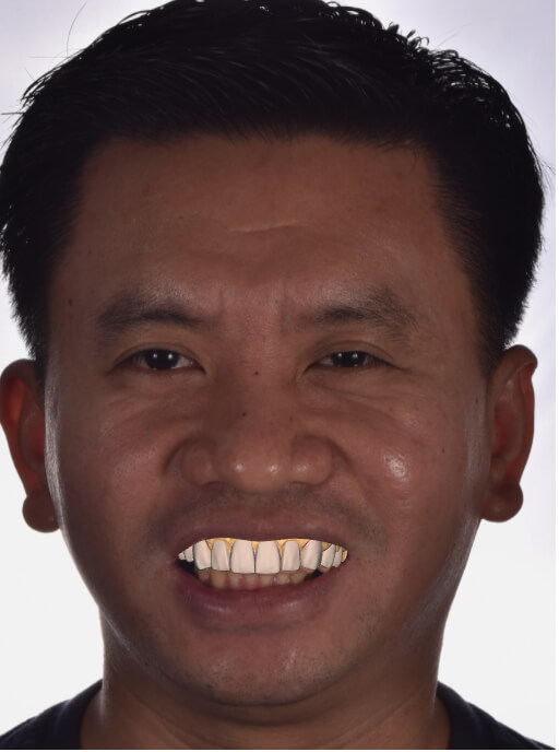 Smile Design