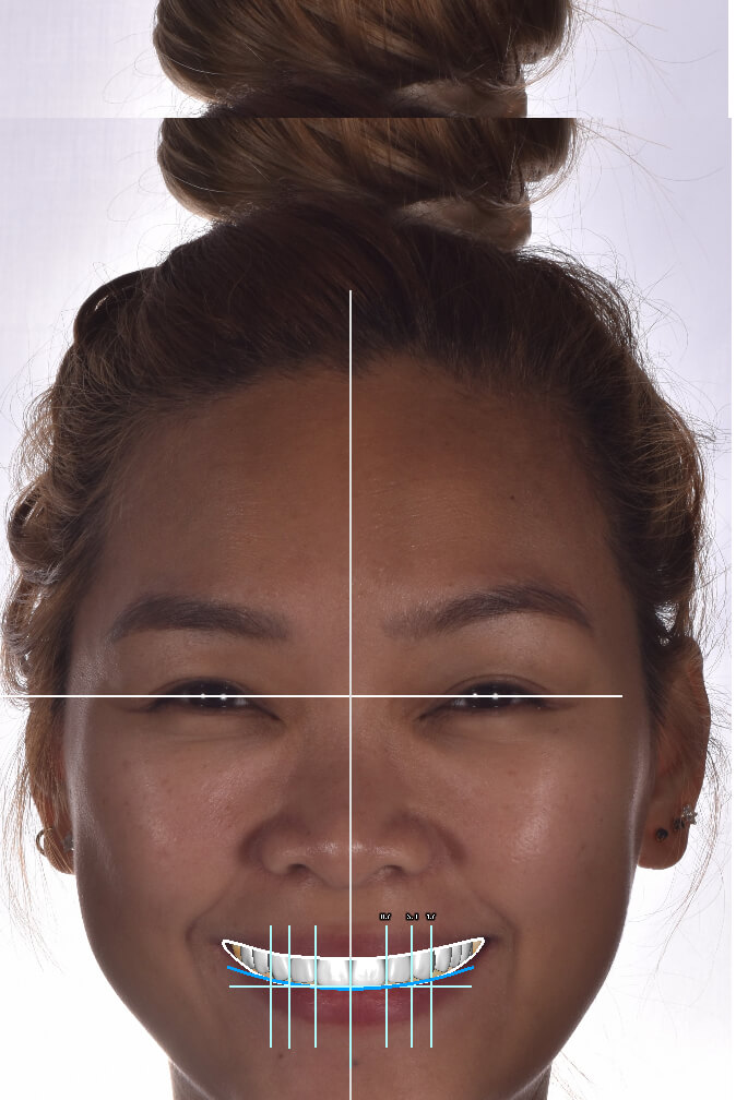 Smile Design