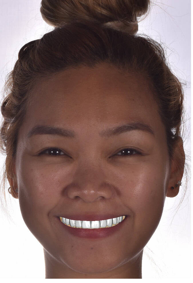 Smile Design